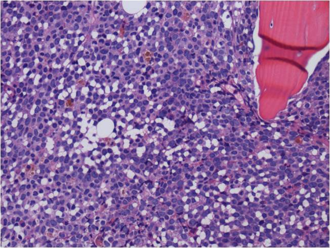 Bone marrow core biopsy demonstrates a hypercellular marrow with trilineage hypoplasia and markedly increased immature cells (H&E, x200).